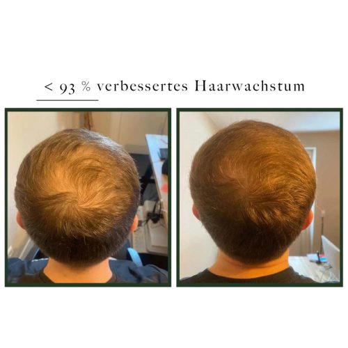 Natucain - Hair Activator - MKMS24 Hajhullás Elleni Tonik 200ml